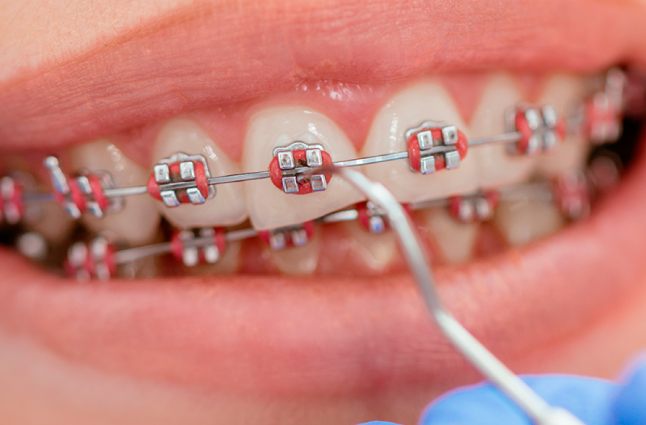 Aparelho odontológico fixo durante manutenção