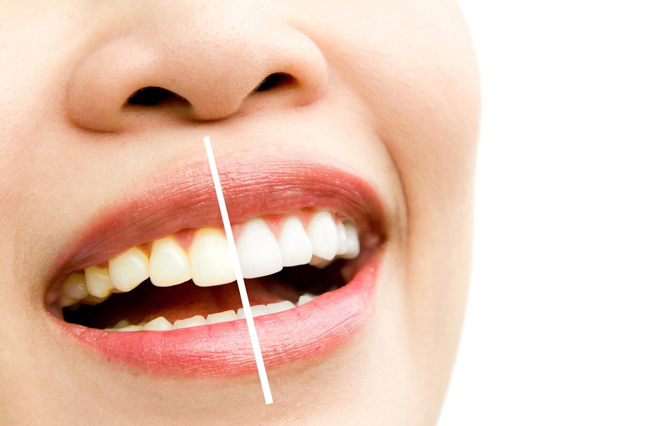 Sorriso representando tratamento de clareamento dental