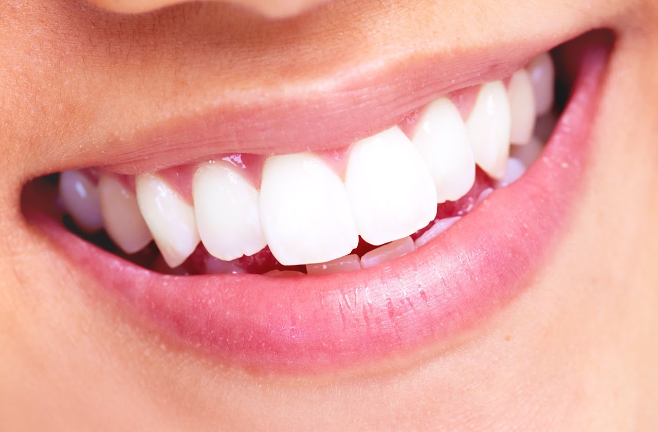 Sorriso natural representando tratamento com facetas em resina