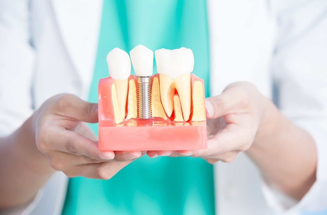 Modelo odontológico demonstrando implante dentário